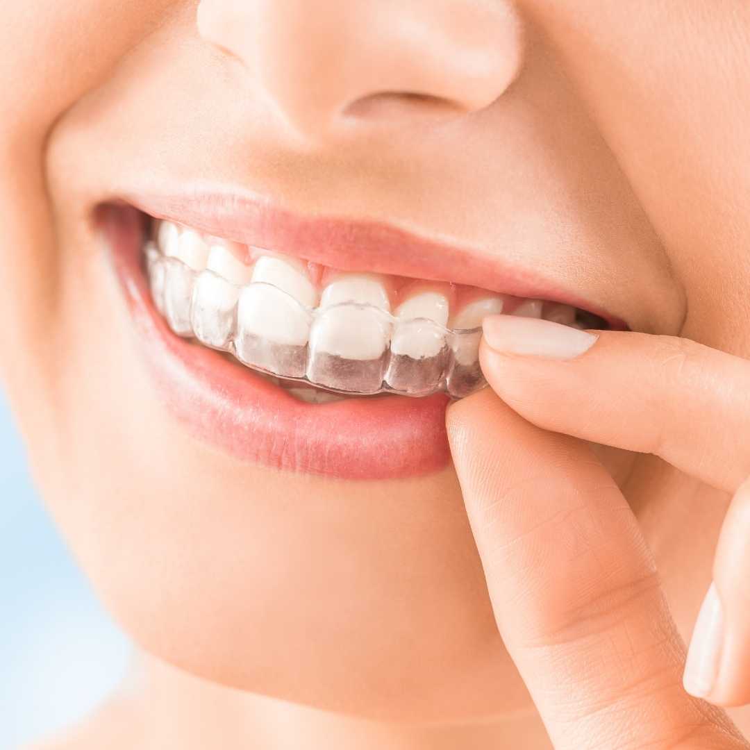 Mouthguards at Crafting Smiles Dentistry in Richmond Hill
